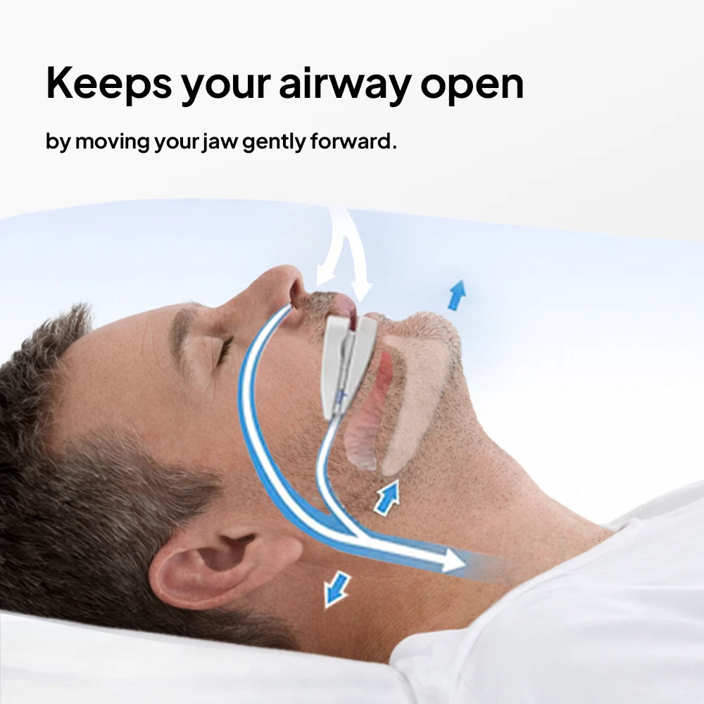 Person lying on their back wearing the anti-snoring mouthpiece, with arrows showing how it helps keep the airway open by moving the jaw gently forward