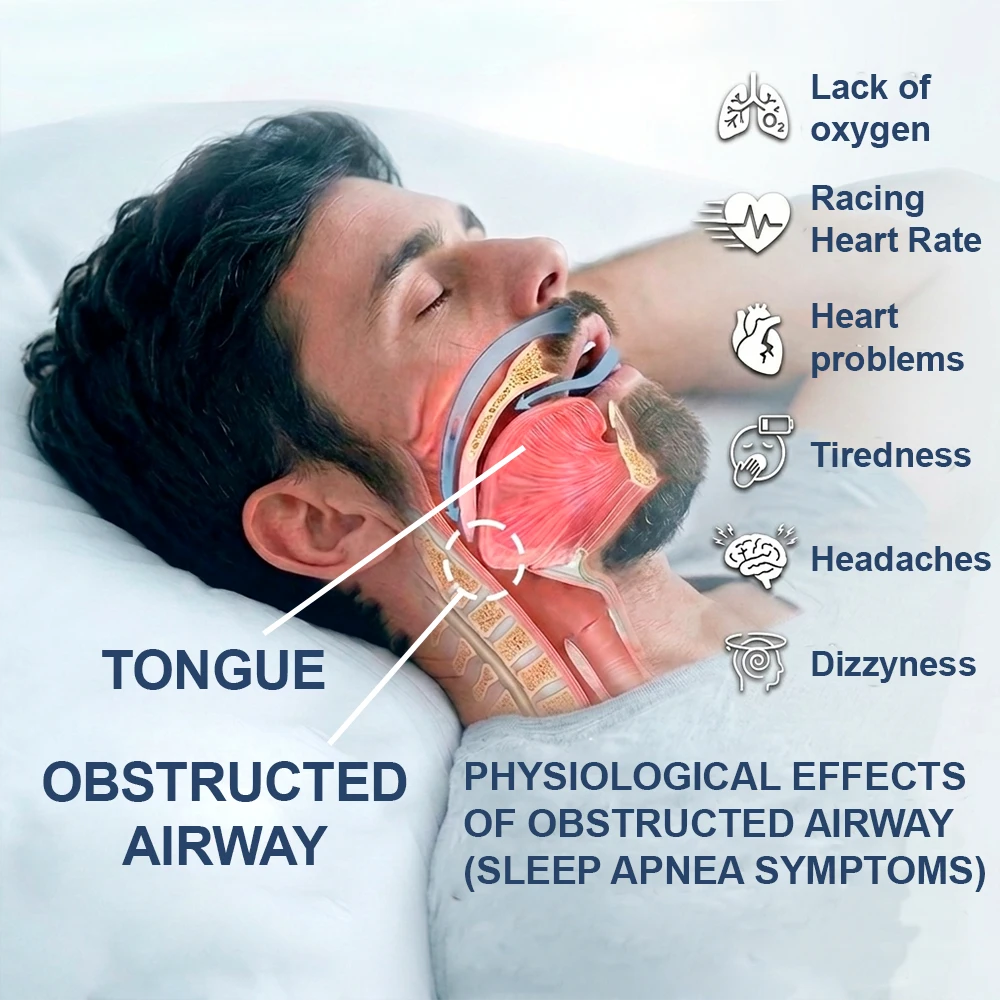 WHAT CAUSES SNORING?